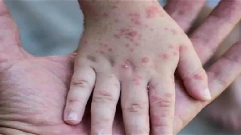 Europe remains 'epicentre' of monkeypox outbreak: WHO