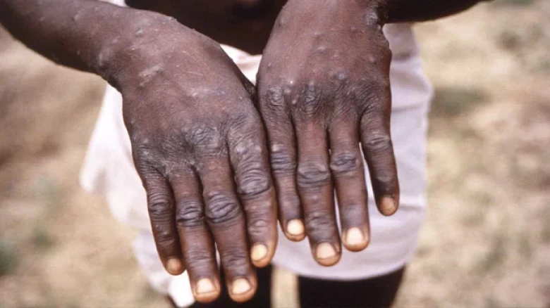 Kerala Reports Another Monkeypox Case, 7th In India
