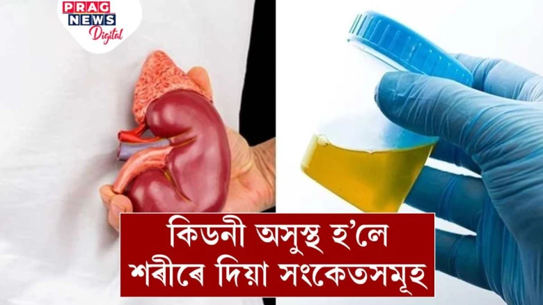 কিডনীত সমস্যা হ’লে শৰীৰে এনে সংকেত দিয়ে! আওকাণ নকৰিব