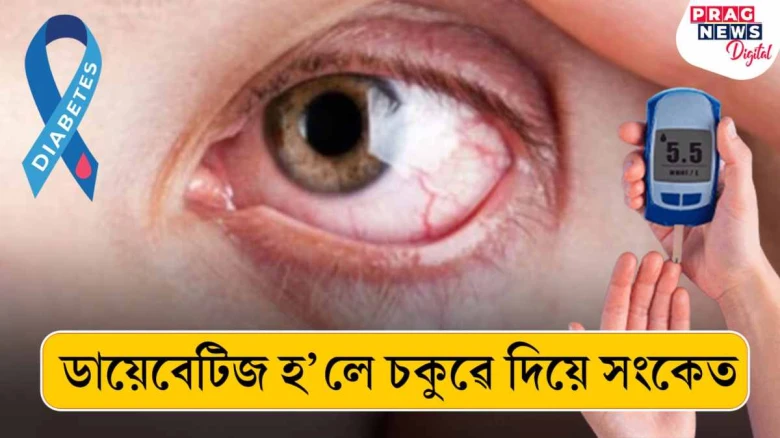 ডায়েবেটিজ হ’লে চকুৱে দিয়ে সংকেত! সাৱধান হওক