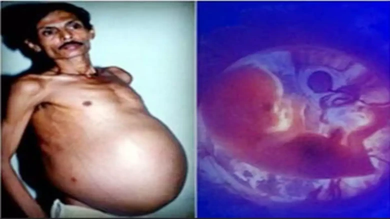 In Rare Medical Condition, Nagpur Man Was 'Pregnant' With Twin for more than three decades