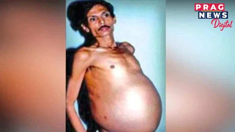 ওলোটা পুৰাণ ! নাগপুৰত পুৰুষৰ গৰ্ভত  যমজ সন্তানৰ উপস্থিতি দেখি দাঁতে ওঁঠে কামোৰ খালে চিকিৎসকে