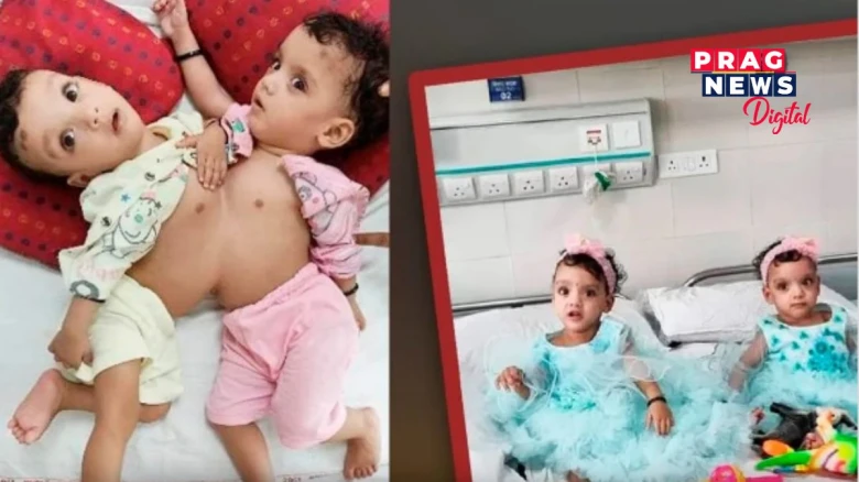 চিকিৎসকৰ চমৎকাৰ! পৃথক কৰিবলৈ সক্ষম হ’ল সংলগ্ন হৈ থকা যমজ ভগ্নীক