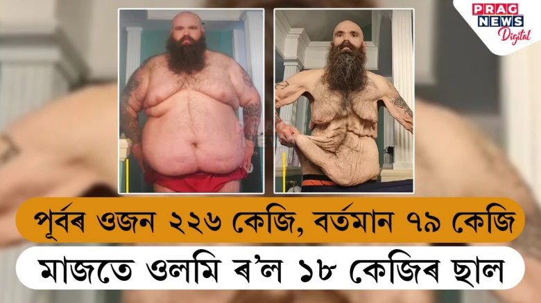 ২২৬ কেজিৰ যুৱকে কমালে ১৪৭ কেজি ওজন! পাছে ওলমি পৰিল ১৮ কেজিৰ ছাল