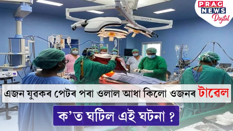 অদ্ভুত ঘটনা; যুৱকৰ পেটত ওলাল আধা কিলো ওজনৰ টাৱেল