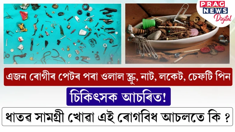 ধাতুৰ সামগ্ৰী খোৱা ৰোগত আক্ৰান্ত এজন ব্যক্তি; অস্ত্ৰোপচাৰত কি কি পালে চিকিৎসকে?