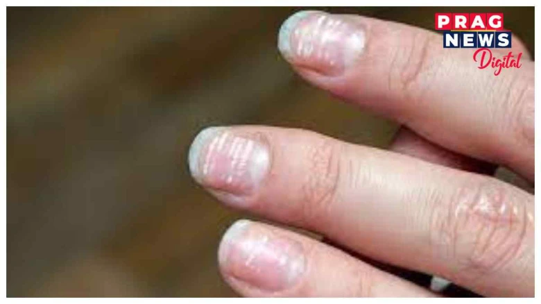 নখ বগা হৈ পৰিছে নেকি? হ’ব পাৰে এনে ৰোগৰ লক্ষণ