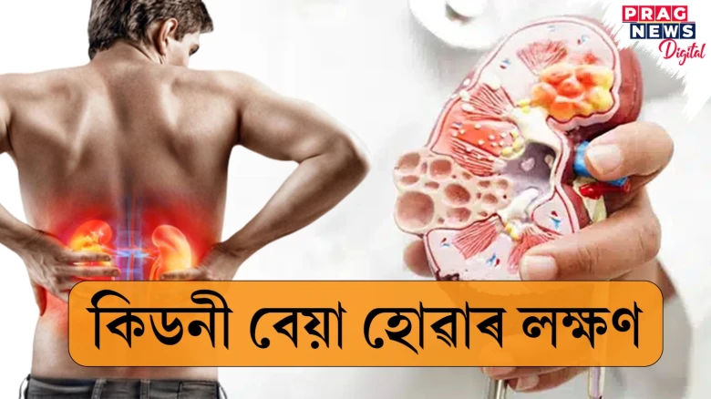 শৰীৰত এই লক্ষণ দেখা দিয়াৰ লগে লগে বুজিব যে কিডনীৰ ক্ষতি হৈছে! এইদৰে সুৰক্ষা লওক