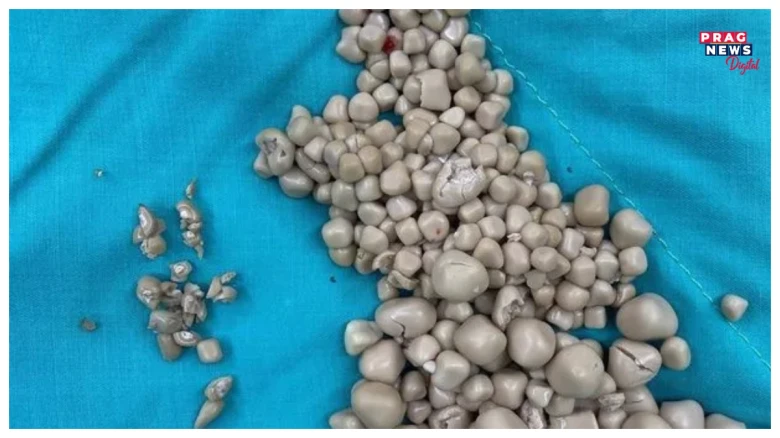 এগৰাকী মহিলাৰ কিডনীৰ পৰা ৩০০টাকৈ ষ্ট’ন আঁতৰাবলৈ সক্ষম হ’ল টাইৱানৰ চিকিৎসকে, কিয় হৈছিল ইমানসংখ্যক কিডনী ষ্ট’ন?