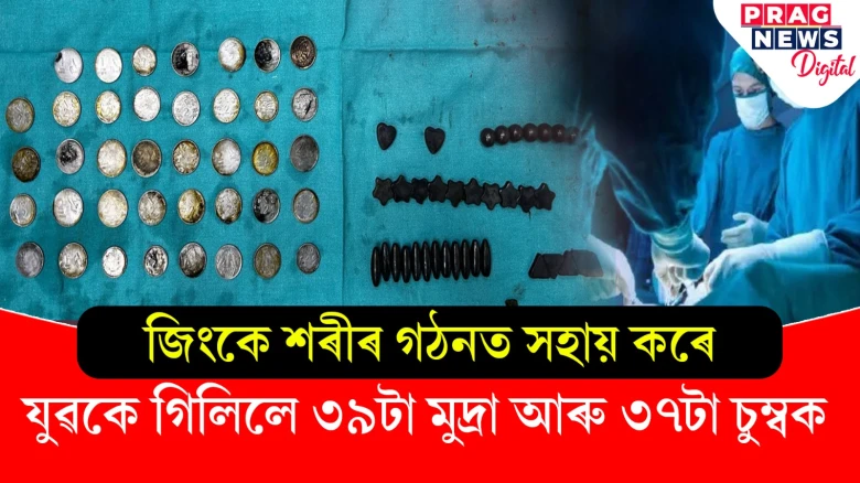 যুৱকৰ পেটৰ পৰা চিকিৎসকে উলিয়ালে ৩৯টা মুদ্ৰা আৰু ৩৭টা চুম্বক! কিয় খালে এই অখাদ্য?