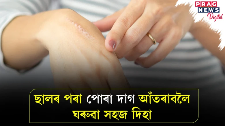 ছালৰ পৰা পোৰা দাগ আঁতৰাবলৈ এই ঘৰুৱা উপায় গ্ৰহণ কৰক! পোৰা দাগ নাইকিয়া হৈ যাব