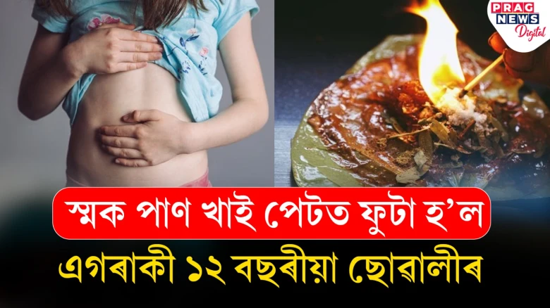 স্মক পাণ খাই পেটত ফুটা হল কিশোৰীৰ! কাটিবলগীয়া হ’ল এটা অংশ