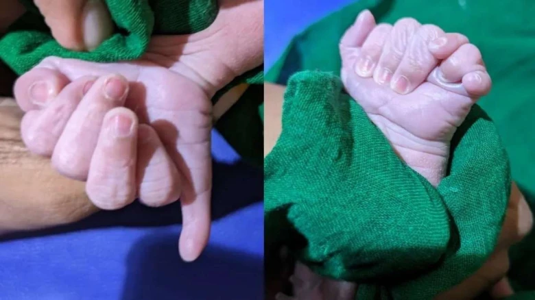 Baby born with 13 fingers and 12 toes in Karnataka, family hails as divine blessing