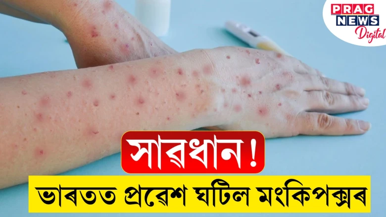 সাৱধান! মংকিপক্সত আক্ৰান্ত এজন ৰোগী ধৰা পৰিলে ভাৰতত