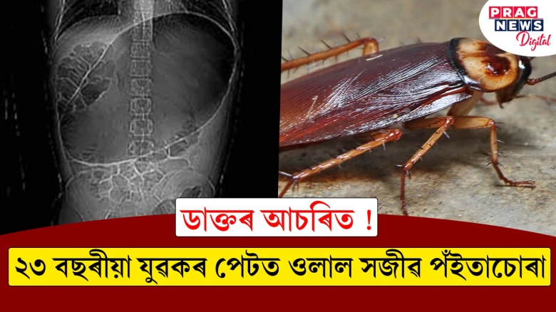 এক আশ্চৰ্যজনক ঘটনা ; বহুদিন ধৰি এজন ২৩ বছৰীয়া যুৱকৰ পেটত সোমাই থাকিল এটা জীৱন্ত পঁইতাচোৰা