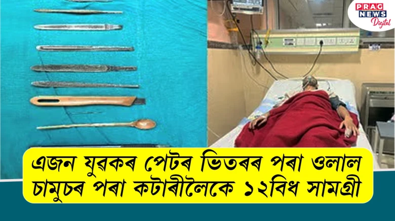 এটা আজৱ ঘটনা, এজন যুৱকৰ পেটৰ ভিতৰৰ পৰা ওলাল চামুচৰ পৰা কটাৰীলৈকে ১২বিধ সামগ্ৰী