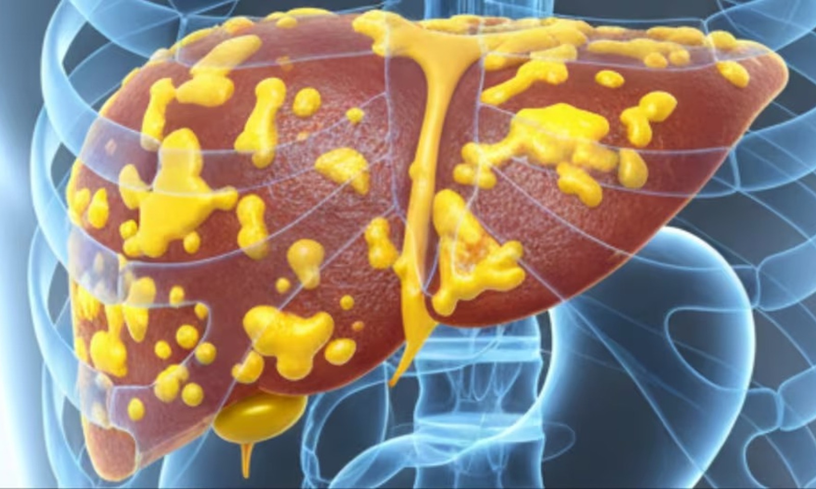 লিভাৰ বেয়া হোৱাৰ ১৪টা লক্ষণ; জানি লওক আৰু সাৱধান হওক