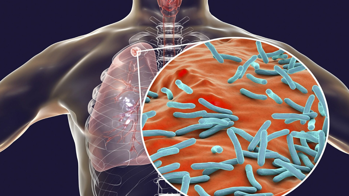 চলিত বর্ষত দেশত ডেৰগুণ বাঢ়িল যক্ষ্মা ৰোগী, সুদূৰপৰাহত কেন্দ্ৰীয় চৰকাৰৰ লক্ষ্য