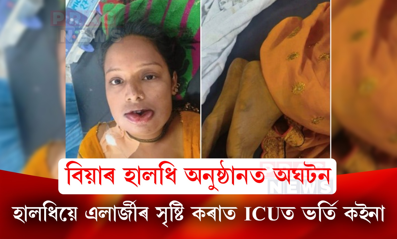 বিয়াৰ হালধি অনুষ্ঠানত হালধি লগাই ICUত ভৰ্তি কইনা