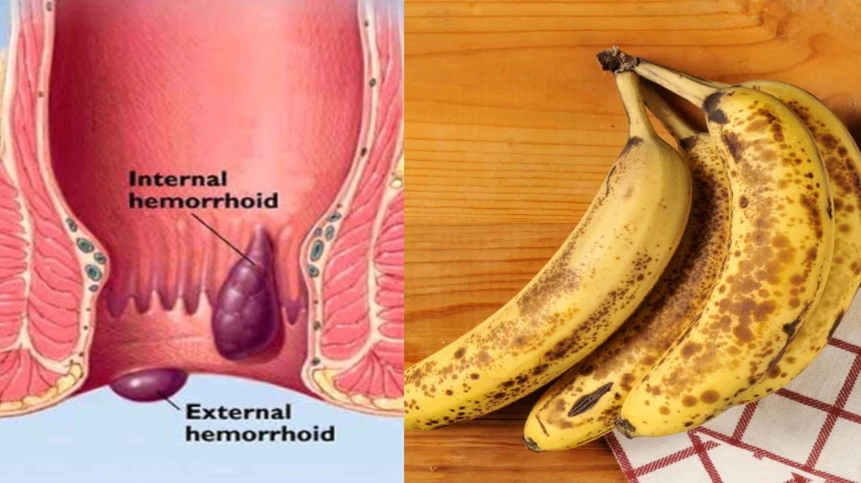 Banana for piles: Know when and how to eat bananas according to Ayurveda