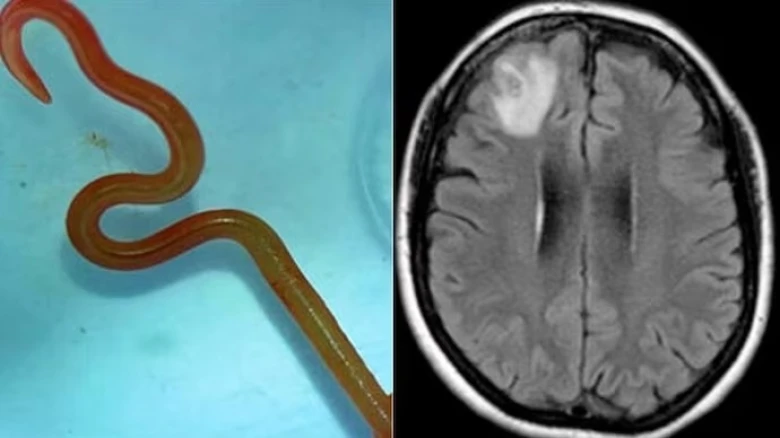 OMG: Live Parasitic Worm Found in Australian Woman's Brain in World-First Discovery