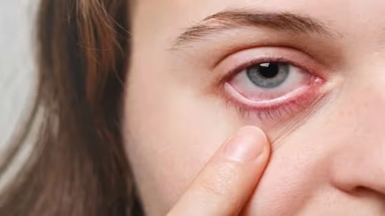 New COVID-19 Symptoms: Is Pink Eye a Warning Sign of This Deadly Variant? Here's Everything You Need to Know