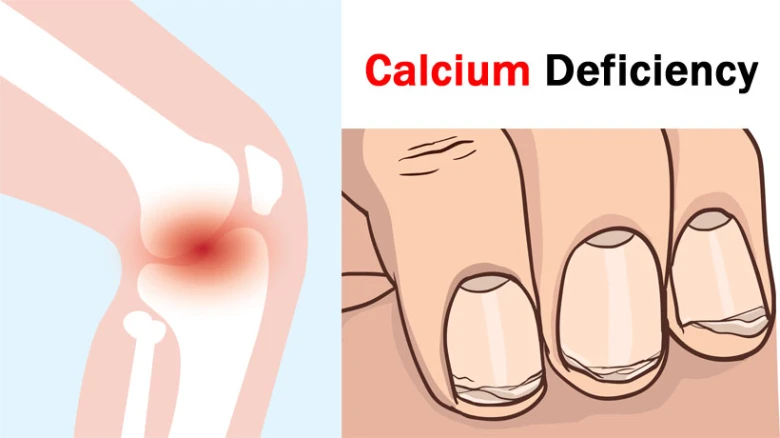 Calcium Deficiency in Women: 5 Signs that indicate Low Levels of Calcium in Body