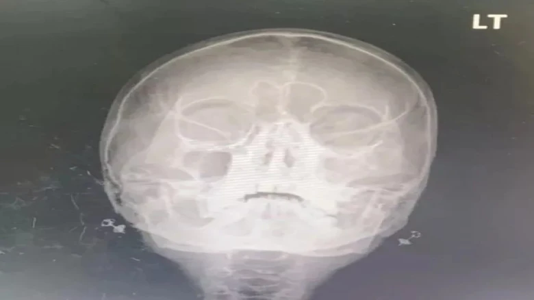 Woman's Nasal Horror: Hundreds of Maggots Found Inside Her Nostrils
