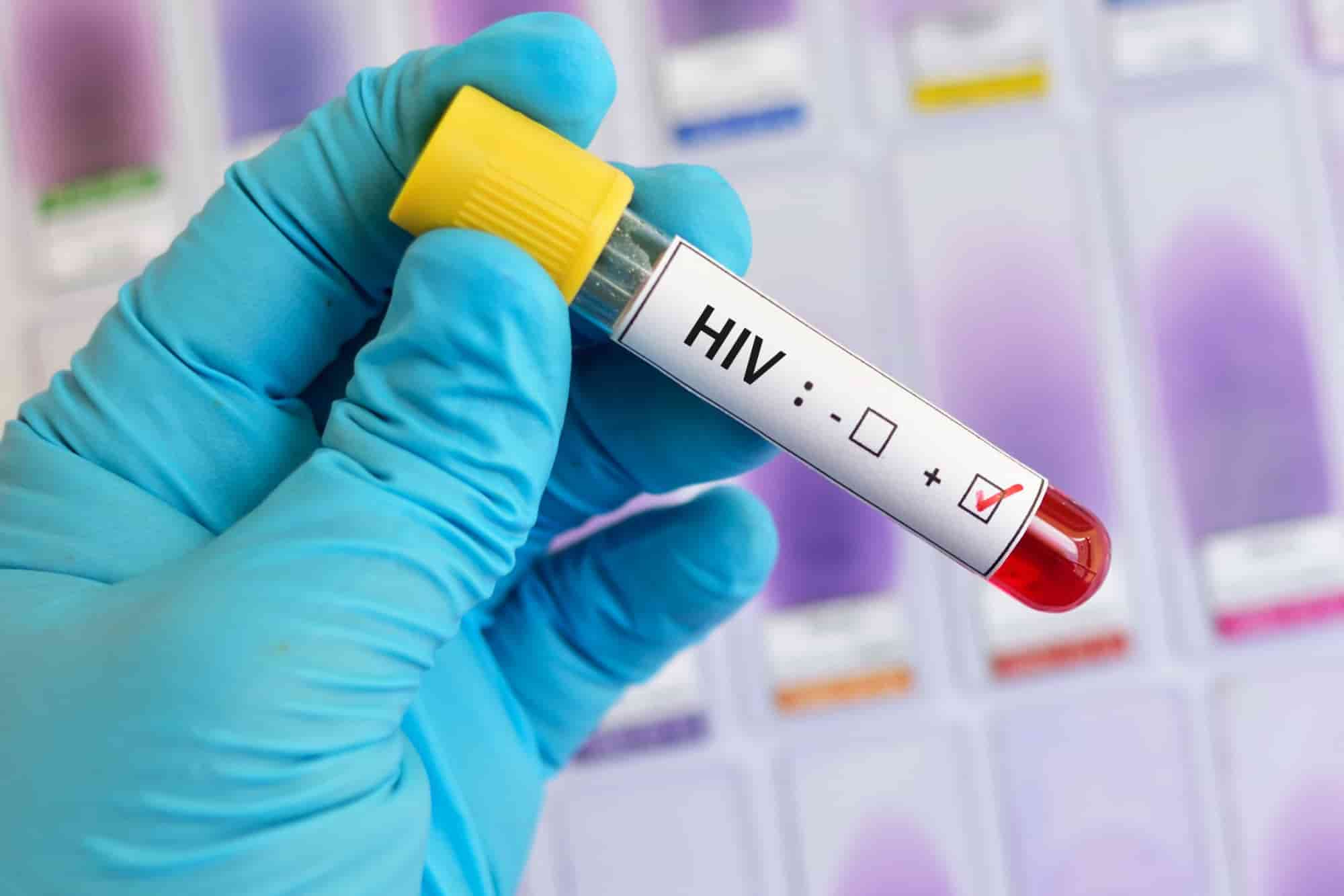 HIV Treatment: First woman to be cured via a stem cell transplant - Prag  News | Best Assamese News Channel | Assam News Live Breaking News